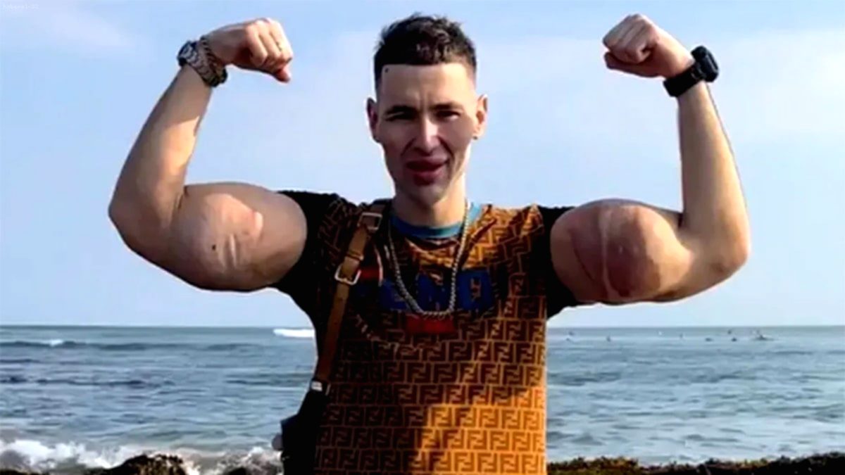 'Rus Temel Reis' Kirill Tereshin, Kolunu Kaybetme Tehlikesiyle Karşı Karşıya