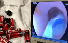 Ağrı Cezaevinde Kan Donduran Olay: Mahkum Midesinden 9 Pil ve 3 Jilet Çıkarıldı!